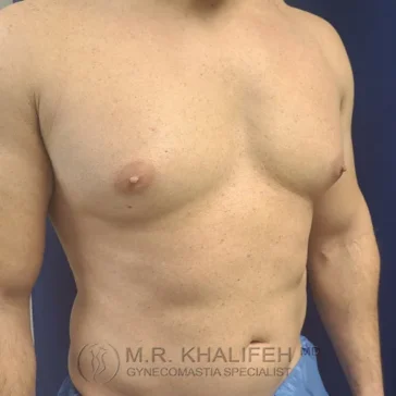 Shirtless man with mild gynecomastia, standing against a dark blue background. Text on image reads “M.R. Khalifeh, MD, Gynecomastia Specialist.”.