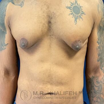 Bare-chested person with visible gynecomastia and multiple tattoos on chest and arms, standing against a blue background.