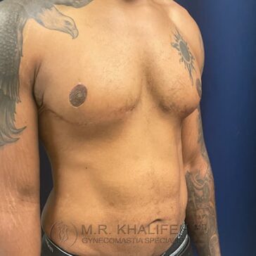 A shirtless man with tattoos on his left arm and chest stands against a dark blue background, showing a flat chest after gynecomastia surgery.