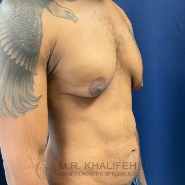 A shirtless man with a chest tattoo stands sideways, showing enlarged breast tissue on his left chest against a blue background.