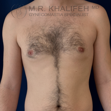 A bare-chested person stands against a dark background, showing natural chest hair growth and no visible signs of gynecomastia.