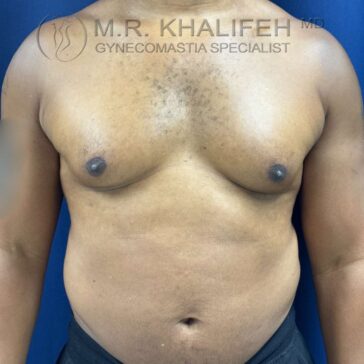 A person with gynecomastia, showing enlarged breast tissue on the chest, stands against a blue background.