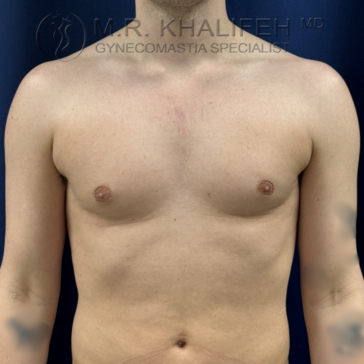 A shirtless person with a flat chest and visible nipple area, standing against a dark background. The image includes a watermark for a gynecomastia specialist.