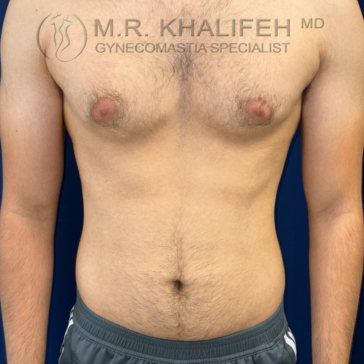 A shirtless person stands facing forward, showing mild gynecomastia. The background is blue, and text overlay identifies a gynecomastia specialist.