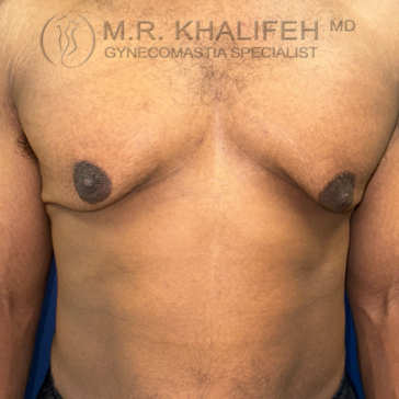 A shirtless person with visible gynecomastia, showing enlarged breast tissue on both sides of the chest, against a blue background.