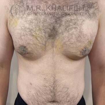 A man's bare chest showing signs of gynecomastia and faint yellowish bruising; physician and specialist information is watermarked at the top.