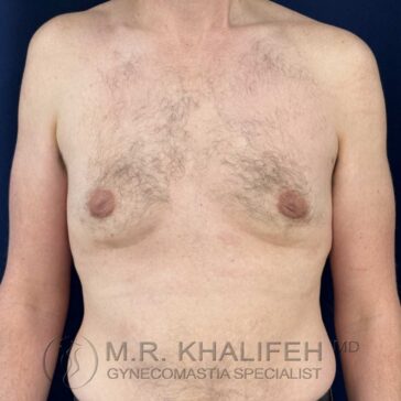 A shirtless adult with visible enlarged breast tissue, standing against a plain background. Text at bottom reads "M.R. Khalifeh MD Gynecomastia Specialist.