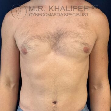 A shirtless person stands facing forward, showing a flat chest and natural skin texture. Logo text above reads "M.R. Khalifeh MD, Gynecomastia Specialist.