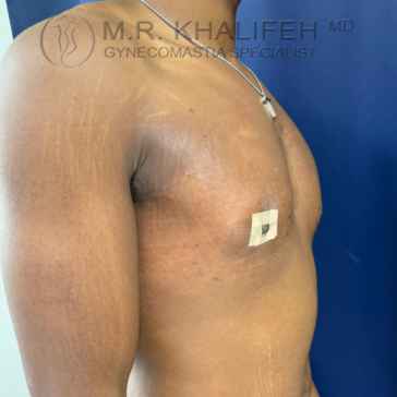 A person’s torso in profile with a medical bandage on the chest, showing possible post-surgical care. Text overlay reads "M.R. Khalifeh MD Gynecomastia Specialist.