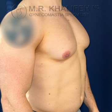 A shirtless male torso is shown from the side with visible enlarged breast tissue, indicating gynecomastia.