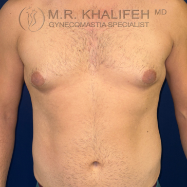 A shirtless adult male torso facing forward, showing prominent breast tissue; text above reads "M.R. Khalifeh MD Gynecomastia Specialist" on a blue background.