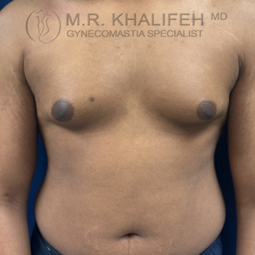 A person with visible gynecomastia, showing enlarged male breast tissue, stands against a blue background.