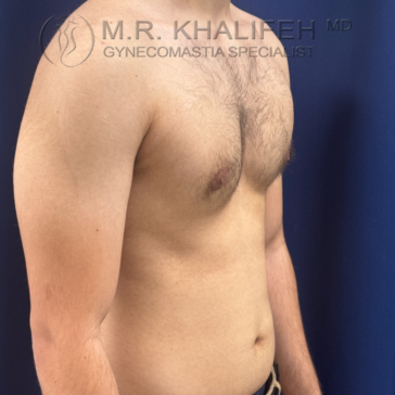 A shirtless person stands against a blue background, showing mild chest swelling. "M.R. Khalifeh MD Gynecomastia Specialist" text is visible at the top of the image.
