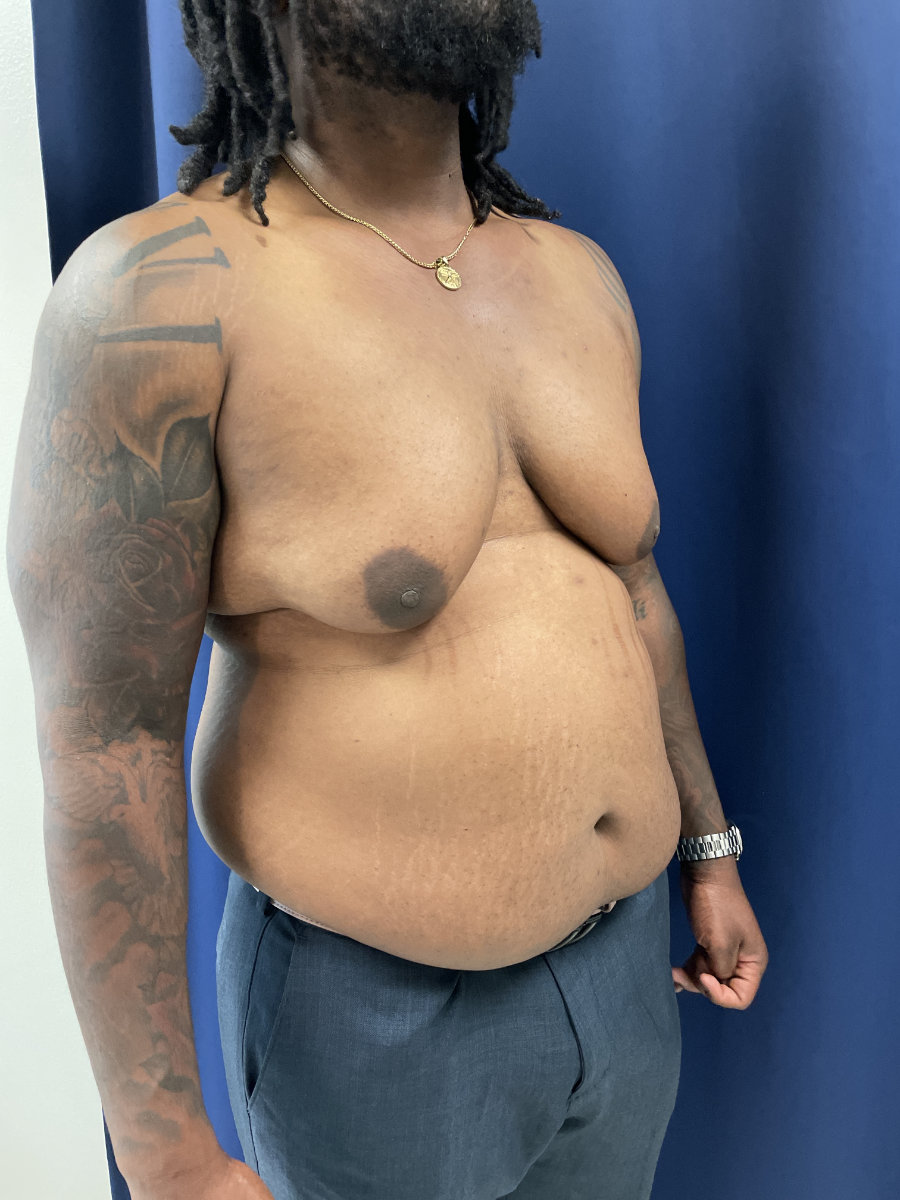 A shirtless person with a visible abdominal bulge and enlarged breast tissue stands in front of a blue curtain.