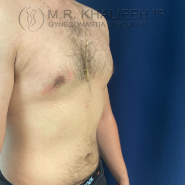A shirtless person with a gold necklace stands against a dark blue background, showing a flat chest with visible scars and hair. "GYNECOMASTIA SPECIALIST" text watermark is present.