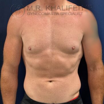 A shirtless adult male with a muscular build stands facing forward against a dark background. The watermark at the top reads "M.R. Khalifeh, MD, Gynecomastia Specialist.