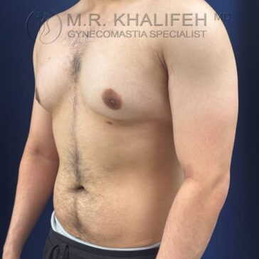 A shirtless man is shown from the shoulders to the waist against a dark background. Text at the top reads "M.R. Khalifeh MD, Gynecomastia Specialist.