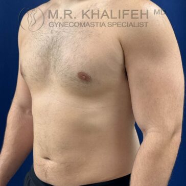 A shirtless adult male is shown from the neck to the waist against a blue background. Text at the top reads "M.R. Khalifeh MD, Gynecomastia Specialist.
