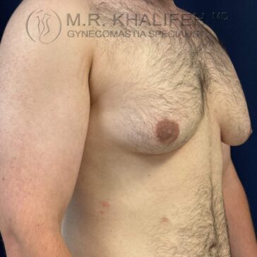 Adult male torso shown from the side with visible gynecomastia, against a dark background. No face is visible. Watermark at the top states "M.R. Khalifeh MD Gynecomastia Specialist.