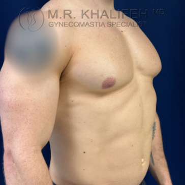 A shirtless person stands in profile, showing a muscular chest and torso with slight gynecomastia on the right side. Medical branding text appears at the top of the image.