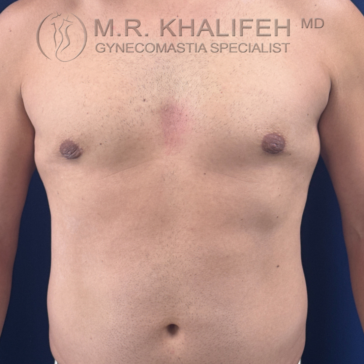 A bare-chested person with minimal body hair stands against a blue background; medical branding and "Gynecomastia Specialist" are visible at the top.
