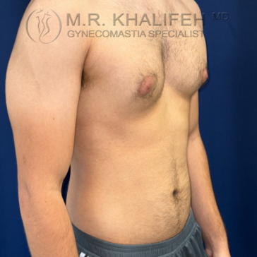 A shirtless male torso with visible gynecomastia, standing against a blue background, with clinic branding at the top.