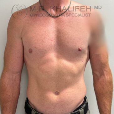 Shirtless adult male standing against a white wall; one side of his chest appears blurred. Text overlay reads: "M.P. Khalifeh MD Gynecomastia Specialist.