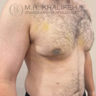 A shirtless person with visible bruising on the chest stands against a plain background. Text at the top reads “M.R. Khalifeh MD Gynecomastia Specialist.”.