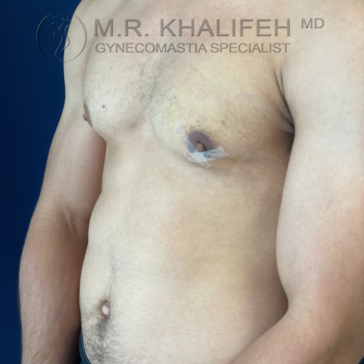 Shirtless male torso with medical tape on chest, showing post-surgery results for gynecomastia. Text overlay reads “M.R. Khalifeh MD Gynecomastia Specialist.”.