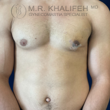 A shirtless person with a bandage on their right chest stands against a plain background. "Gynecomastia Specialist" text is visible at the top of the image.