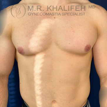 A shirtless person with gynecomastia stands against a blue background. The logo “M.R. Khalifeh MD Gynecomastia Specialist” is visible at the top of the image.