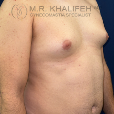 A shirtless adult male torso is shown from the side, displaying visible gynecomastia in the chest area. A clinic logo and the words "Gynecomastia Specialist" appear at the top of the image.