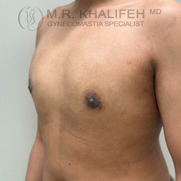 A shirtless person is shown from the shoulders to the waist, with a flat chest. The watermark reads "M.R. Khalifeh MD Gynecomastia Specialist.