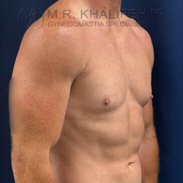 Shirtless adult male torso shown from the side against a plain background; "Gynecomastia Specialist" text is visible at the top of the image.