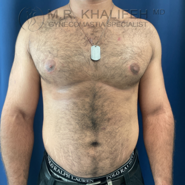 A man’s bare chest and torso are shown against a blue background, wearing a necklace and black underwear. Text at the top mentions a gynecomastia specialist.