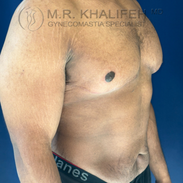Man with visible gynecomastia on the left side of his chest, standing shirtless against a blue background.