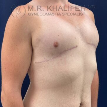 A shirtless person showing chest scars, possibly after surgery, with the text "M.R. Khalifeh MD Gynecomastia Specialist" at the top.