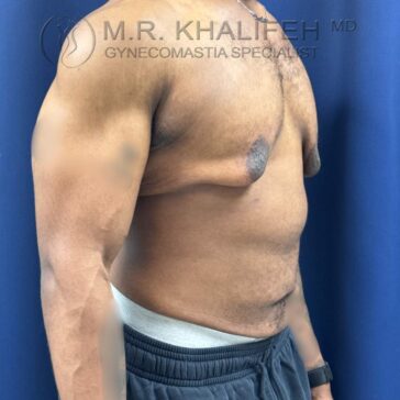 A man stands shirtless in profile against a blue background, showing signs of unilateral gynecomastia on his left chest.