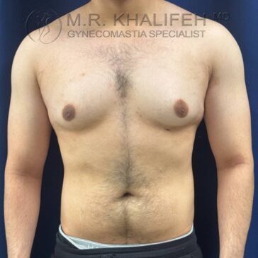 A shirtless person with enlarged male breast tissue stands facing forward against a dark blue background.