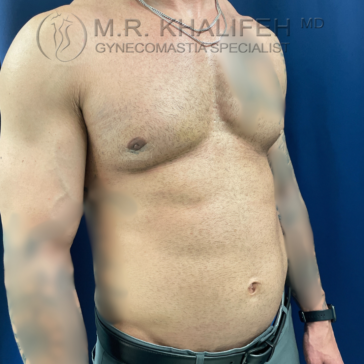 Shirtless adult male standing against a blue background, showing chest and abdomen; medical branding visible at top of image.