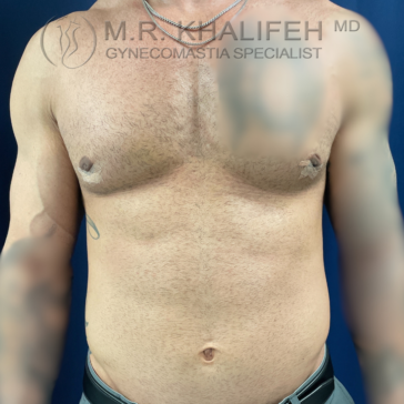 Shirtless male torso showing post-gynecomastia surgery results, with the chest appearing symmetrical and flat. Blurred arms and tattoos are visible.