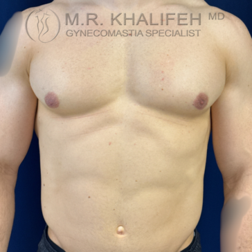 The image shows the bare chest and abdomen of a person with visible gynecomastia, marked by enlarged breast tissue, against a dark background.