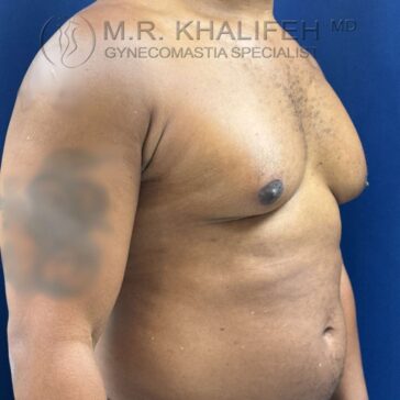Adult male torso shown from the side, displaying visible gynecomastia, with some arm tattoos blurred out; blue background.