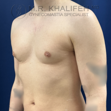 A shirtless person with visible gynecomastia stands in front of a dark blue background. The watermark reads "M.R. Khalifeh MD Gynecomastia Specialist.