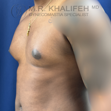 A shirtless man with mild gynecomastia stands in front of a blue background. The text at the top reads "M.R. Khalifeh MD, Gynecomastia Specialist.