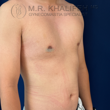 A person with a bare chest stands at an angle, showing a healing area on one side. The words “M.R. Khalifeh MD Gynecomastia Specialist” appear at the top of the image.