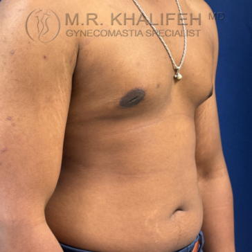 A shirtless person with visible gynecomastia stands against a blue background, wearing a necklace and jeans.