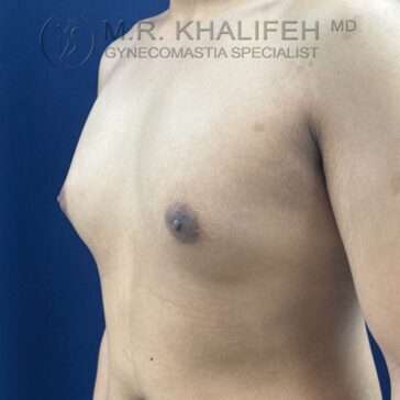 A person’s bare chest is shown from the side, displaying visible gynecomastia. A logo at the top reads "M.R. Khalifeh MD Gynecomastia Specialist.