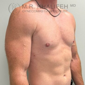 Shirtless adult male facing left, showing chest and upper abdomen. Logo and text at top indicate gynecomastia specialist.