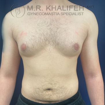 A shirtless person with visible gynecomastia stands against a dark blue background; text at the top reads "M.R. Khalifeh MD Gynecomastia Specialist.